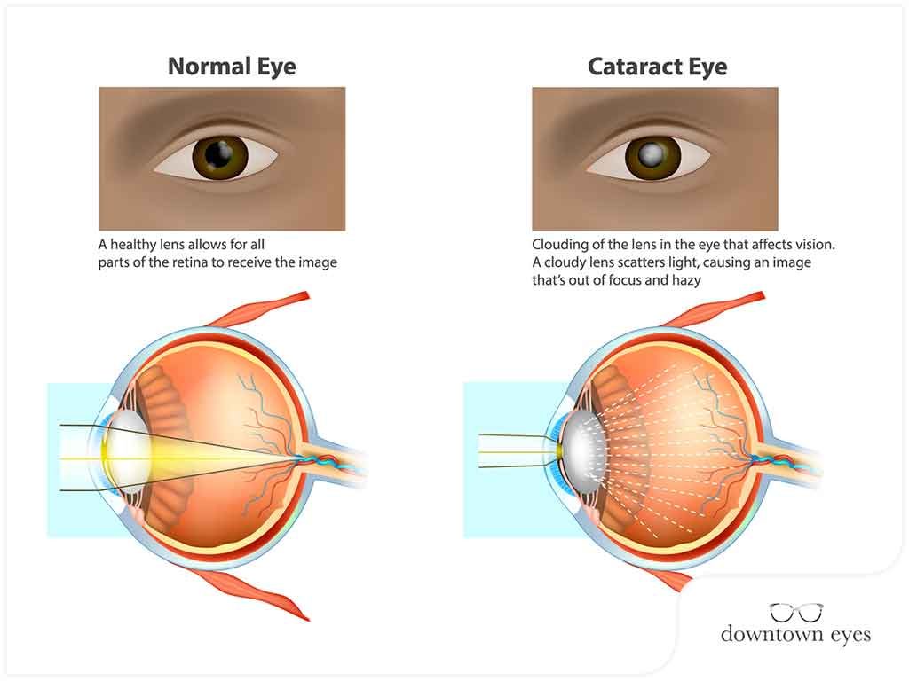 WHY DO WE GET CATARACTS? - Goan Observer