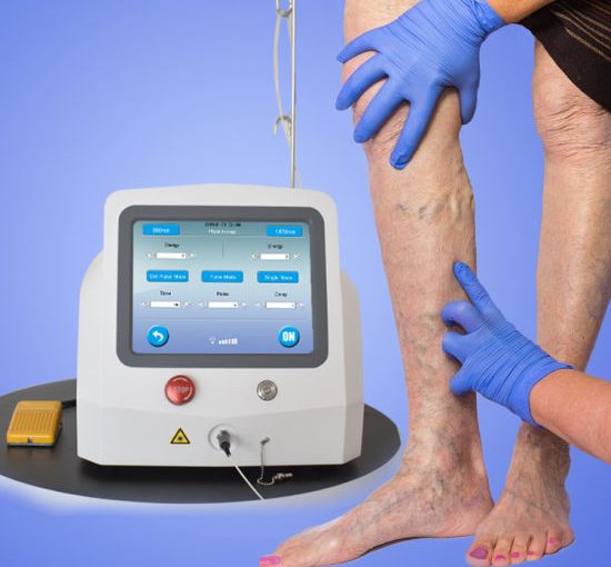 GMC GETS LASER MACHINE FOR VARICOSE VEINS… Incidence of varicose veins high in Goa
