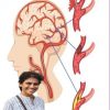 Understanding a stroke and how to prevent it...