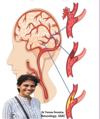 Understanding a stroke and how to prevent it...